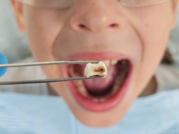 Best Emergency Dental Extractions in Lockney, TX